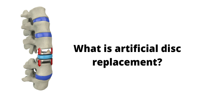 What is artificial disc replacement?